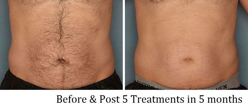 Belly Hair Before After