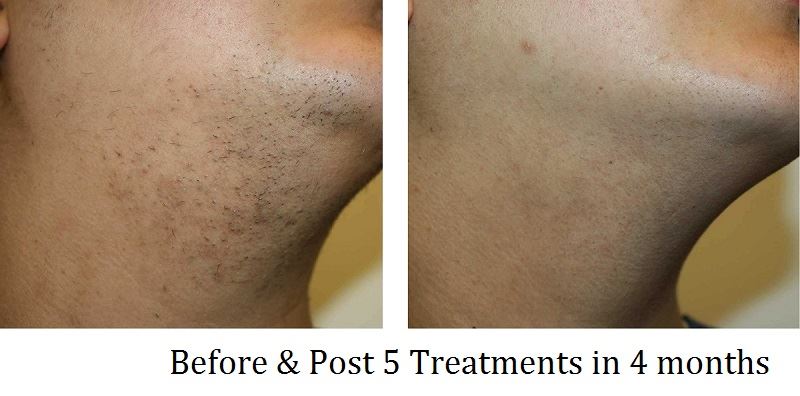 Chin Hair Before After