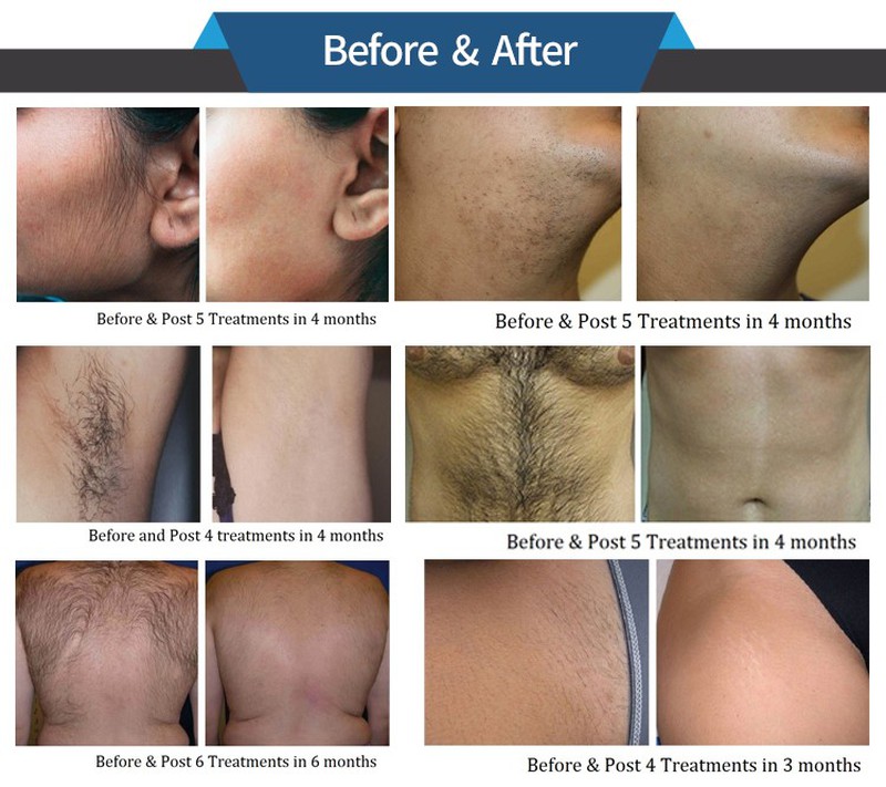 ipl shr hair removal machine5 ipl shr hair removal machine5