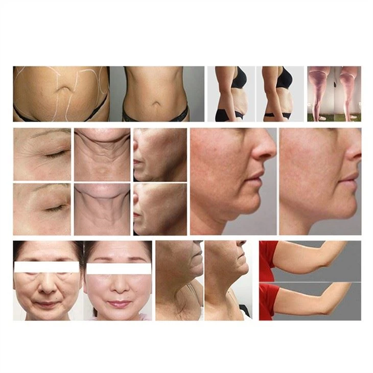 Vacuum RF Roller IR LED 5 in 1 Body Shaping Machine