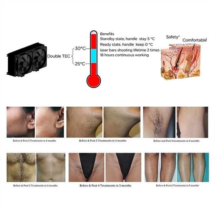Hair Removal 755nm Laser Machine