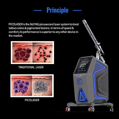 Apakah Penghapusan Tato Laser Meninggalkan Bekas Luka?